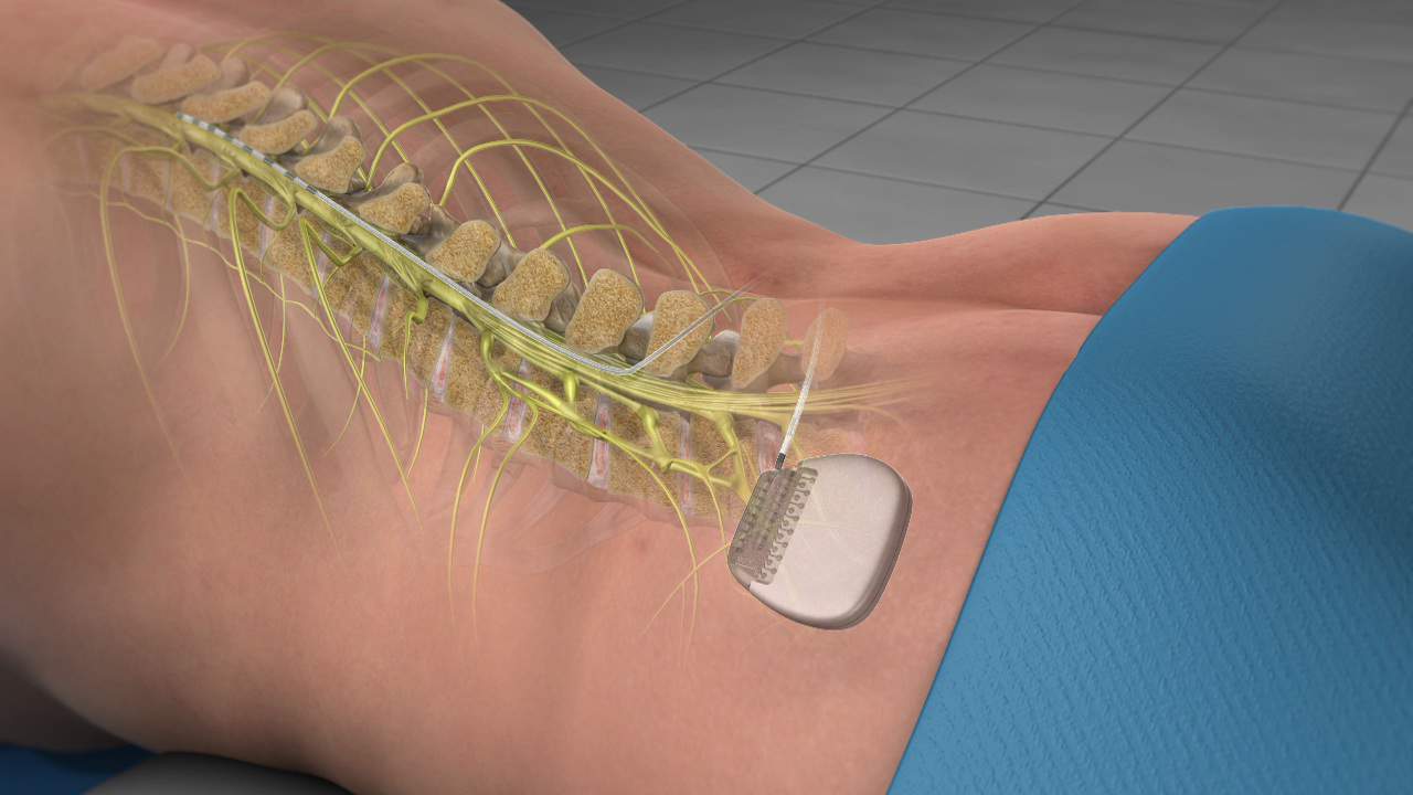 What Is Spinal Cord Stimulation?