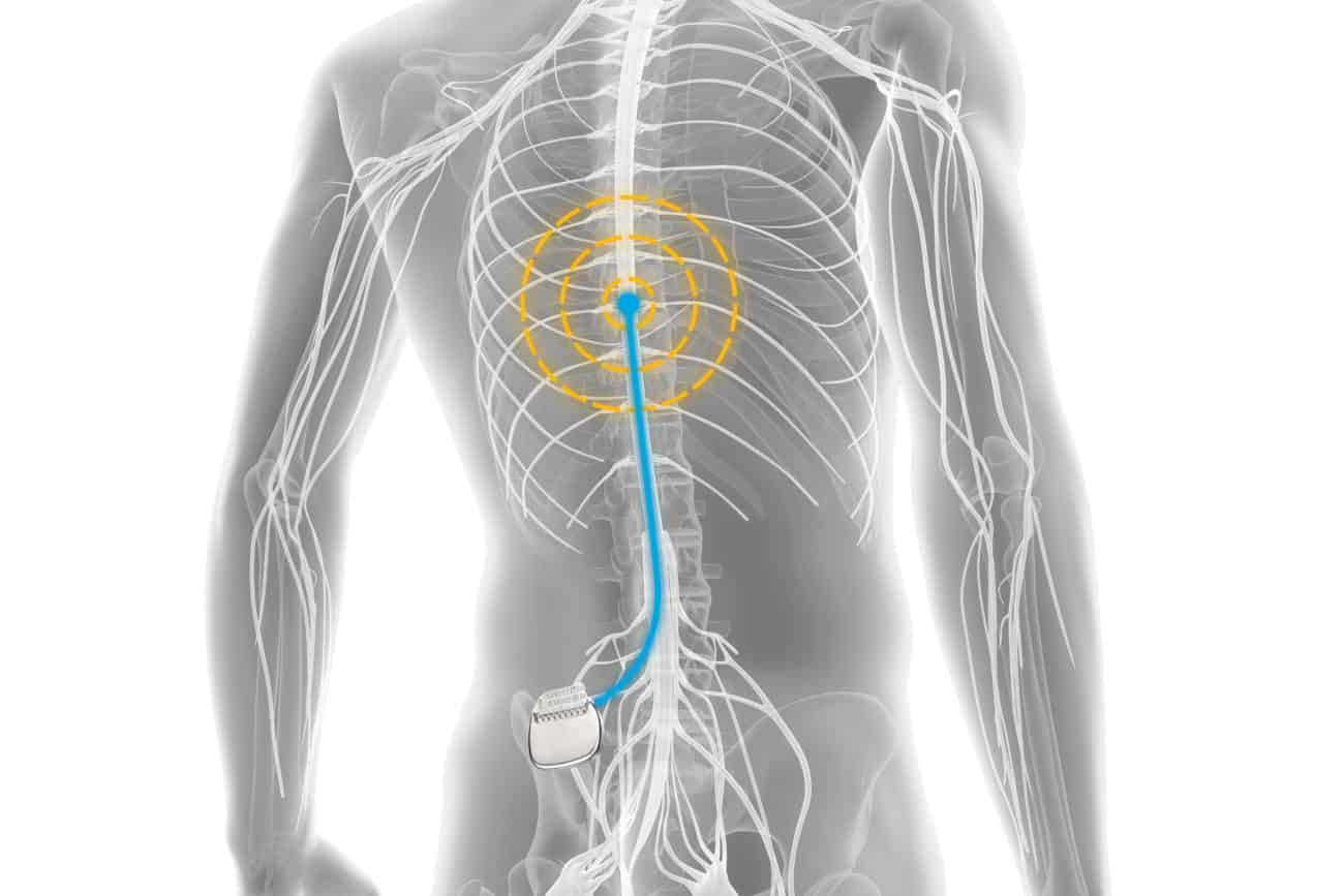 spinal cord stimulator battery replacement cost